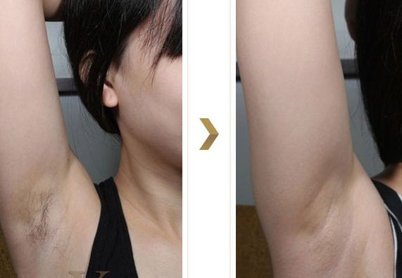 長沙湘雅醫(yī)院的減肥科如何？大腿吸脂效果如何？