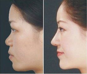 成都邱偉醫(yī)生雙眼皮術(shù)的成功案例分享 成都邱偉醫(yī)生雙眼皮術(shù)的成功案例分享