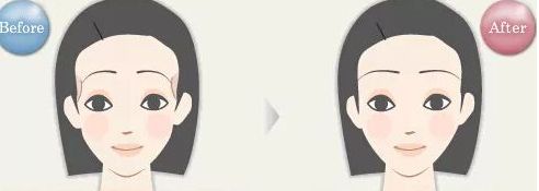 揭密石家莊哪位雙眼皮醫(yī)生備受關(guān)注，優(yōu)點(diǎn)揭秘，價(jià)格參考！