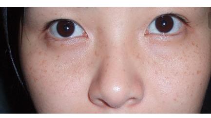 張恒術(shù)雙眼皮手術(shù)80天后效果揭曉，驚喜呈現(xiàn)！