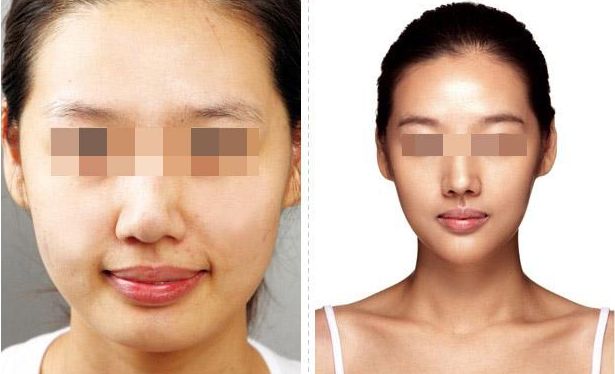 武漢恩娜整形中心：解讀雙眼皮手術(shù)全攻略，案例展示讓你真實(shí)了解效果！