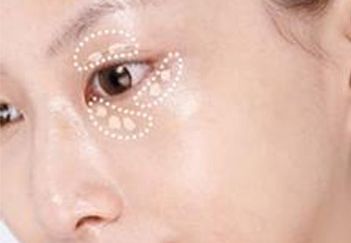 杭州葉秀娣做雙眼皮具體效果如何？專家實(shí)踐案例發(fā)布
