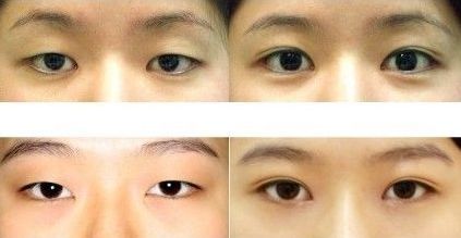 成都雙眼皮修復(fù)醫(yī)生最新名單出爐！頂尖專家蔡玲、王強(qiáng)等領(lǐng)銜榜單