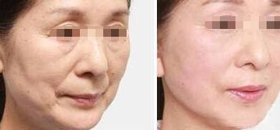 寧波頂級醫(yī)院去眼袋的價格及經(jīng)驗分享 寧波頂級醫(yī)院去眼袋的價格及經(jīng)驗分享