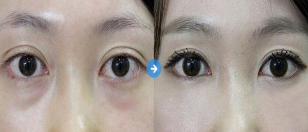 盤點北京7大值得信賴的開眼角整形醫(yī)生 盤點北京7大值得信賴的開眼角整形醫(yī)生