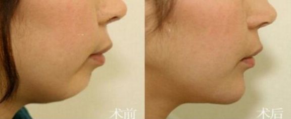 成都這7家專業(yè)豐胸醫(yī)院,不可錯(cuò)過的排名第一 成都這7家專業(yè)豐胸醫(yī)院,不可錯(cuò)過的排名第一