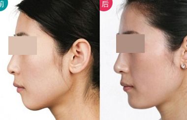 上海哪個(gè)醫(yī)生擅長(zhǎng)鼻翼縮??？2023年度網(wǎng)民口碑推薦醫(yī)生名冊(cè)曝光