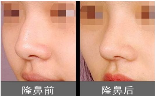上海柴云醫(yī)生雙眼整形效果完美！手術(shù)前后真實照片呈現(xiàn)出專業(yè)水平