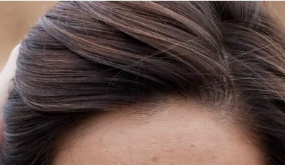 南昌二附院整形科眼袋抽脂效果好嗎？值得醫(yī)生推薦嗎？