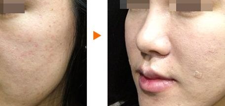 臨安芘麗芙整形醫(yī)院聯(lián)系方式及鼻部整形效果分享 臨安芘麗芙整形醫(yī)院聯(lián)系方式及鼻部整形效果分享
