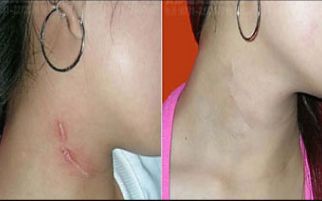 北京首都整形醫(yī)院雙眼皮修復(fù)效果如何？詳細(xì)案例揭秘