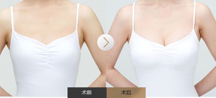 全面了解雙眼皮手術(shù)，揭秘風(fēng)險(xiǎn)與安全