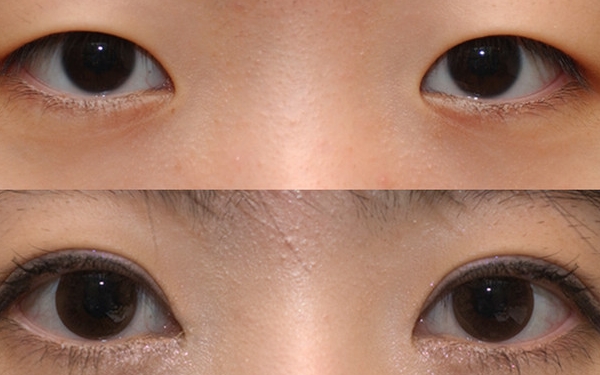 上海哪家醫(yī)院做眼袋手術(shù)價(jià)格實(shí)惠又靠譜？排行榜前十強(qiáng)！