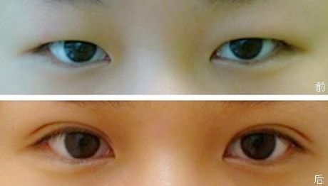 塑造完美鼻型，一觸即達！隆鼻醫(yī)生品牌推薦，成功案例揭秘，費用一覽表震撼來襲