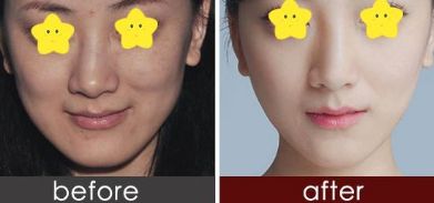 有效消腫的雙眼皮修復(fù)技巧由經(jīng)驗豐富的整形醫(yī)生分享 有效消腫的雙眼皮修復(fù)技巧由經(jīng)驗豐富的整形醫(yī)生分享