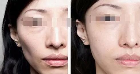 注射隆鼻，需要了解的材料有哪些？