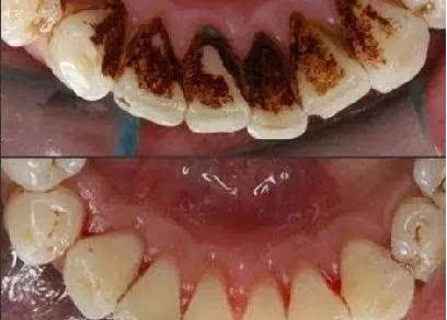 上海蝶可變整形醫(yī)院豐胸案例新鮮發(fā)布，引領(lǐng)時尚潮流