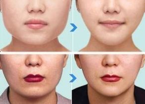 杭州哪家醫(yī)院做下頜角整形效果好？綜合口碑、價(jià)格受好評的幾家醫(yī)院推薦