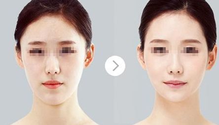 內(nèi)蒙古呼和浩特填充硅膠隆鼻有何獨(dú)特之處？五種整形手術(shù)方式綜合對(duì)比！