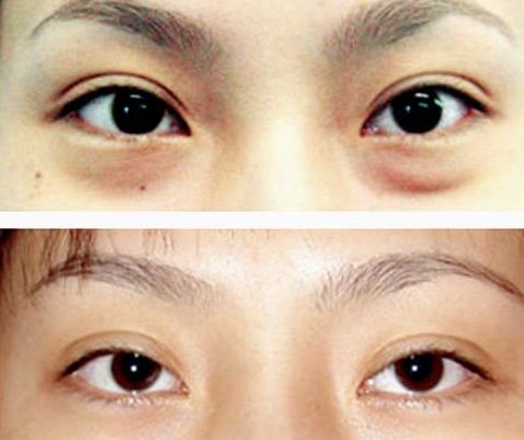 謝錦清：醫(yī)術(shù)高超，雙眼皮案例解析曝光！