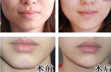 廣州人中縮短手術(shù)醫(yī)生推薦？網(wǎng)友真實(shí)評價(jià)與信息公開！