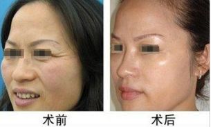 常見(jiàn)需要整形的手術(shù)嘴唇類型