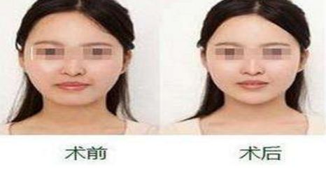 揚(yáng)州隆胸專家2024榜單評(píng)選揭曉：挑選胸部整形領(lǐng)域翹楚！