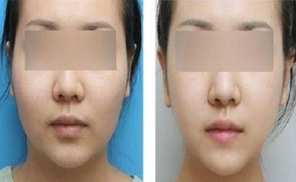 廣州上眼皮下垂匹配專業(yè)矯正整形醫(yī)院 廣州上眼皮下垂匹配專業(yè)矯正整形醫(yī)院