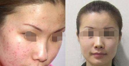 沈陽哪家醫(yī)院可以有效去除皺紋 沈陽哪家醫(yī)院可以有效去除皺紋