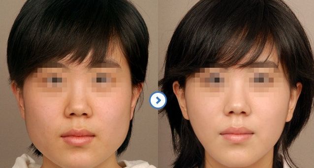 成都隆鼻醫(yī)生排行榜2024：專家推薦的醫(yī)院大揭秘！