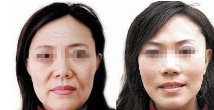 成都自然雙眼皮去哪家醫(yī)院靠譜？