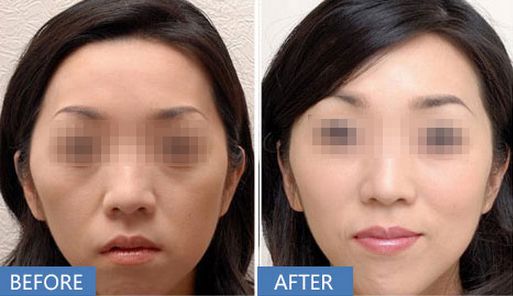 上海哪家醫(yī)院做打玻尿酸除皺效果好？