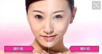 廣州哪家醫(yī)院可以安全進(jìn)行拉皮手術(shù)？