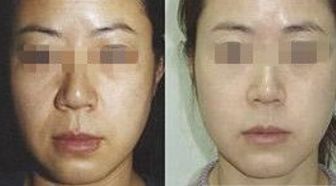 王自謙脂肪移植，存活率高受追捧