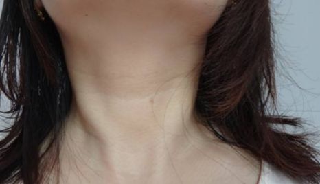 無錫臥蠶手術哪家醫(yī)院做得好？江南大學附屬醫(yī)院高鳳山，整形外科主任醫(yī)師給您解答
