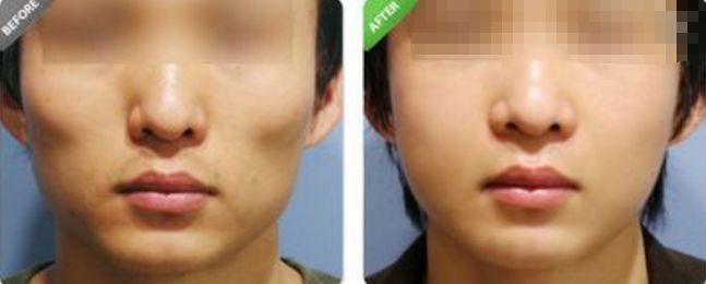 深圳哪家醫(yī)院的拉皮除皺效果最好？排名前幾位的醫(yī)院有哪些？