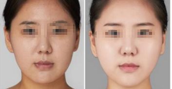 上海八院脂肪填充手術費如何？專家拆解詳情及特色優(yōu)勢