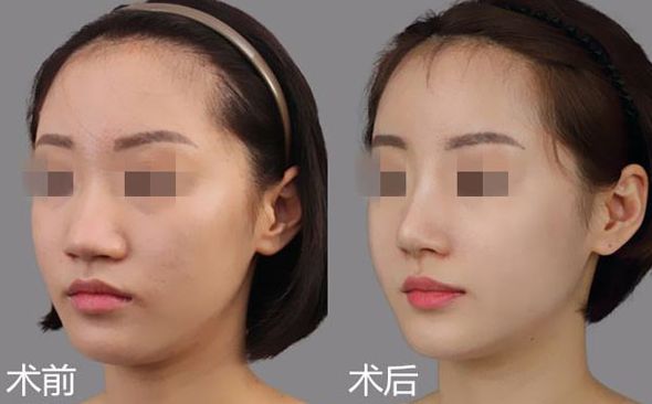 廣州拉皮哪家醫(yī)生技術(shù)比較好？TOP5名醫(yī)大揭秘