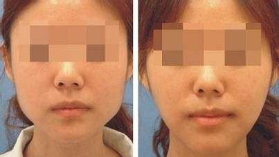 上海哪家醫(yī)院的下巴隆鼻手術(shù)效果最好？