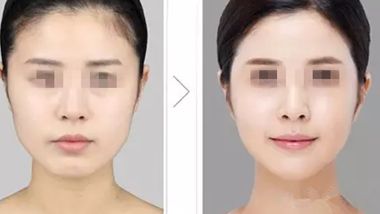 長沙雙眼皮整形醫(yī)院推薦，哪家效果更好？