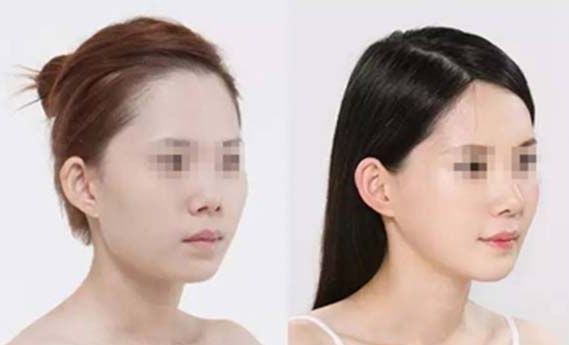 杭州雙眼皮專家推薦:排行榜前四強(qiáng)醫(yī)院評測 杭州雙眼皮專家推薦:排行榜前四強(qiáng)醫(yī)院評測