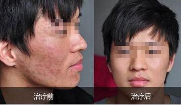 重慶吸脂哪家好？華美吸脂專家經(jīng)驗豐富，安全保障