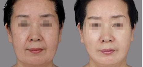 樂山哪家整形醫(yī)院雙眼皮比較好？匯總單六強(qiáng)預(yù)測