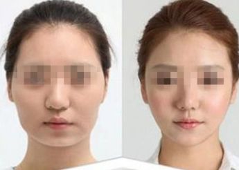 南寧市哪家醫(yī)院做雙眼皮好？