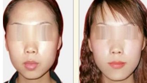 荊州哪個(gè)醫(yī)院能做隆鼻手術(shù)效果好？