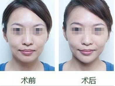 成都更受歡迎的脂肪填充技術(shù)推薦 成都更受歡迎的脂肪填充技術(shù)推薦