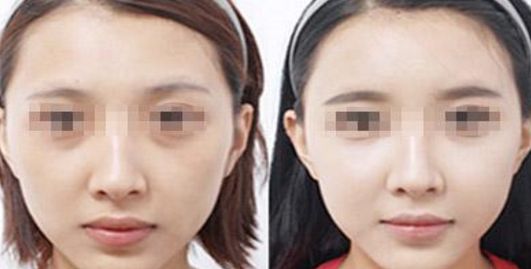 邯鄲哪家醫(yī)院做乳房整形效果好？
