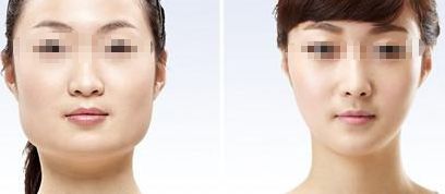 咸陽哪家醫(yī)院做雙眼皮好？醫(yī)院推薦！