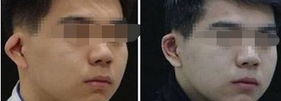 北京三甲隆胸醫(yī)院排名公布：哪家醫(yī)院技術(shù)過硬，值得信賴？