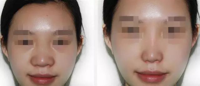 哈爾濱哪家醫(yī)院做隆鼻好？醫(yī)療技術(shù)排行幫你快速選擇